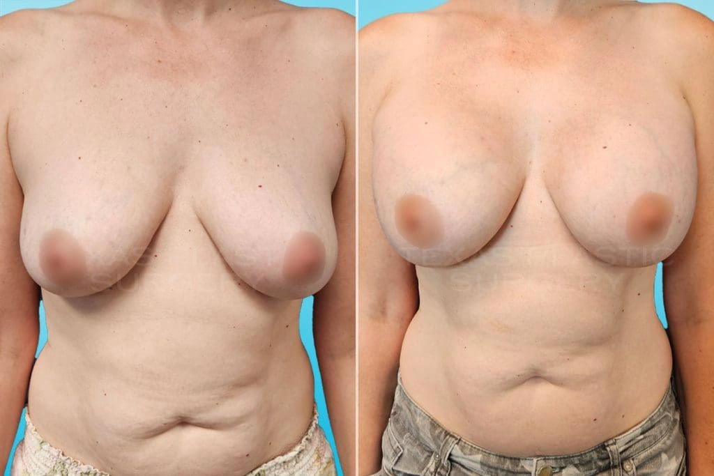 Real Patient results in San Antonio, TX Performed by Texas Plastic Surgery