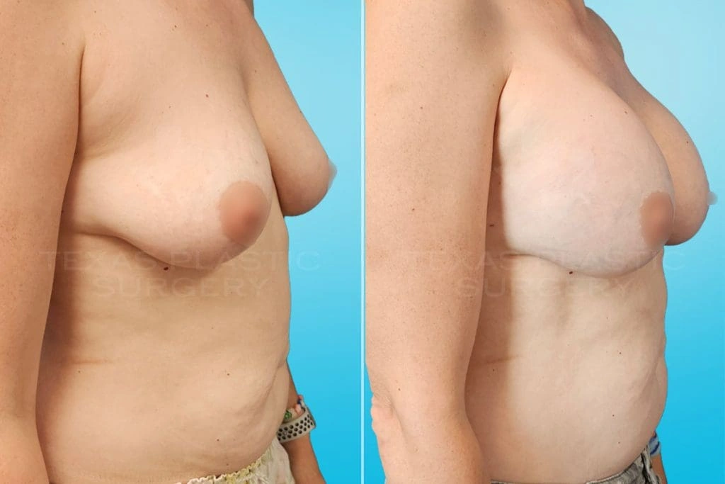 Real Patient results in San Antonio, TX Performed by Texas Plastic Surgery