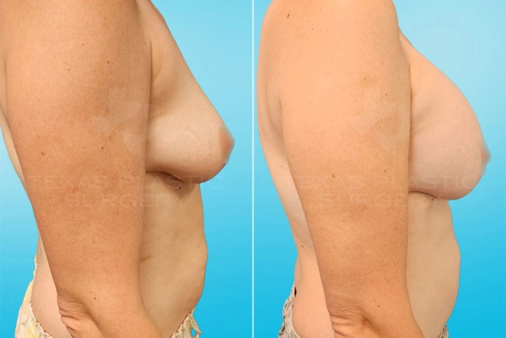 Real Patient results in San Antonio, TX Performed by Texas Plastic Surgery