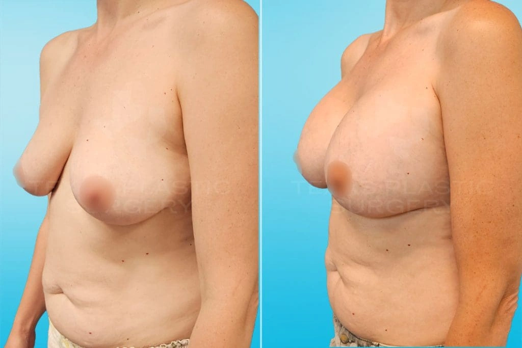 Real Patient results in San Antonio, TX Performed by Texas Plastic Surgery