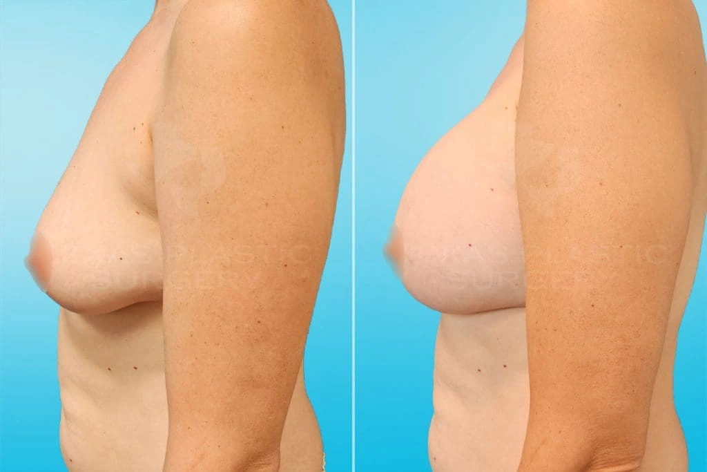 Real Patient results in San Antonio, TX Performed by Texas Plastic Surgery