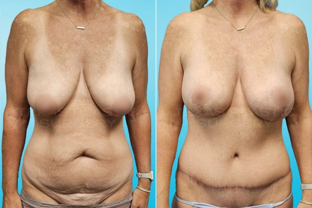 Real Patient results in San Antonio, TX Performed by Texas Plastic Surgery