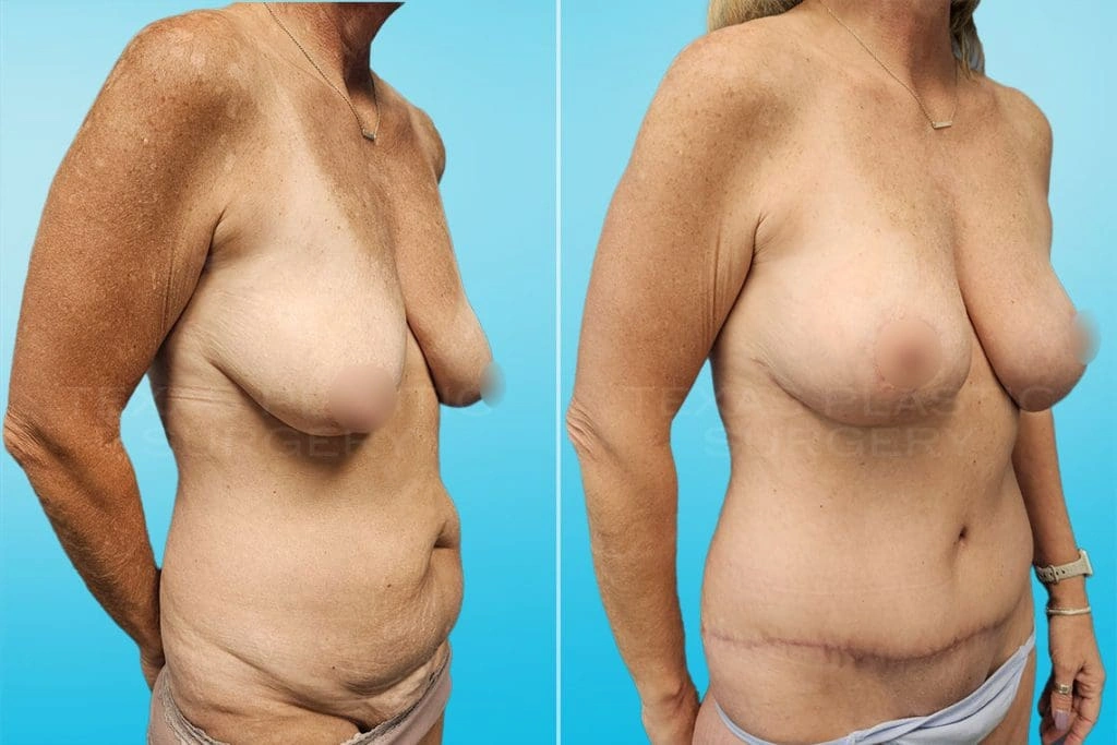Real Patient results in San Antonio, TX Performed by Texas Plastic Surgery