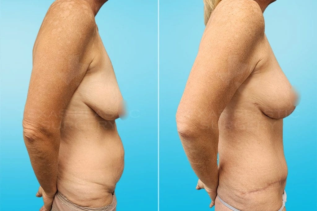 Real Patient results in San Antonio, TX Performed by Texas Plastic Surgery