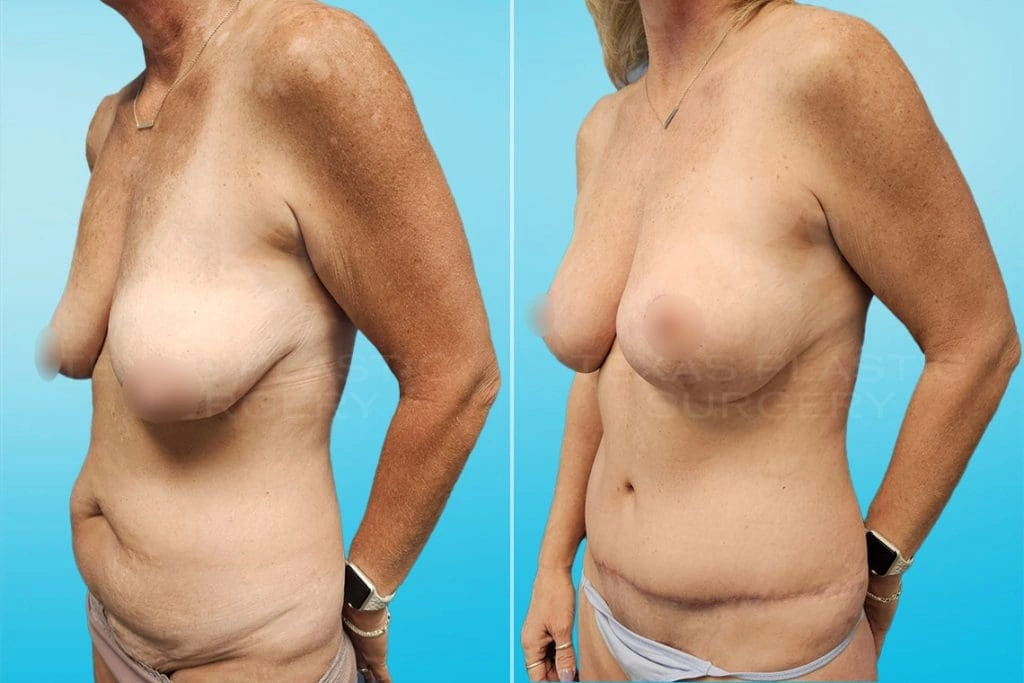 Real Patient results in San Antonio, TX Performed by Texas Plastic Surgery