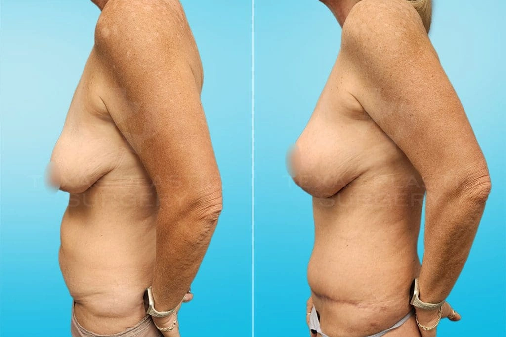 Real Patient results in San Antonio, TX Performed by Texas Plastic Surgery