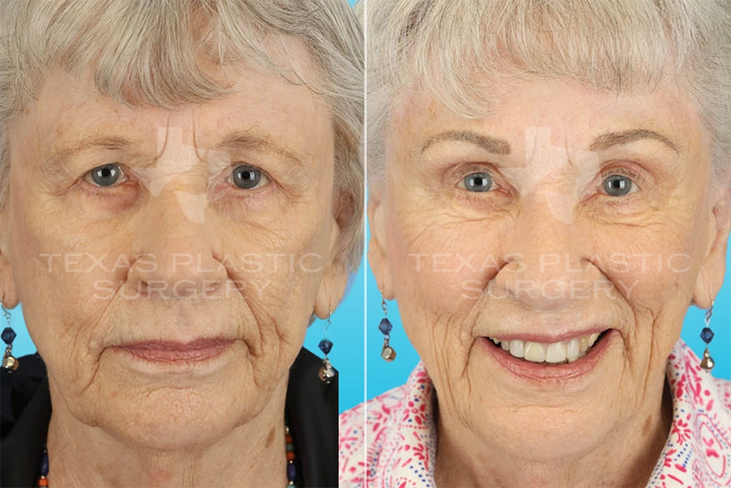 Real Patient results in San Antonio, TX Performed by Texas Plastic Surgery