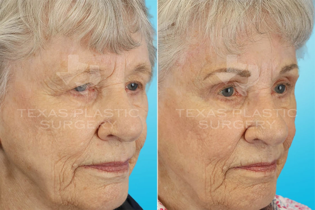 Real Patient results in San Antonio, TX Performed by Texas Plastic Surgery