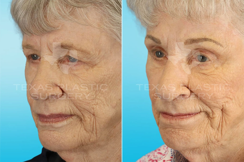 Real Patient results in San Antonio, TX Performed by Texas Plastic Surgery