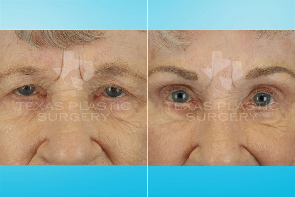 Real Patient results in San Antonio, TX Performed by Texas Plastic Surgery