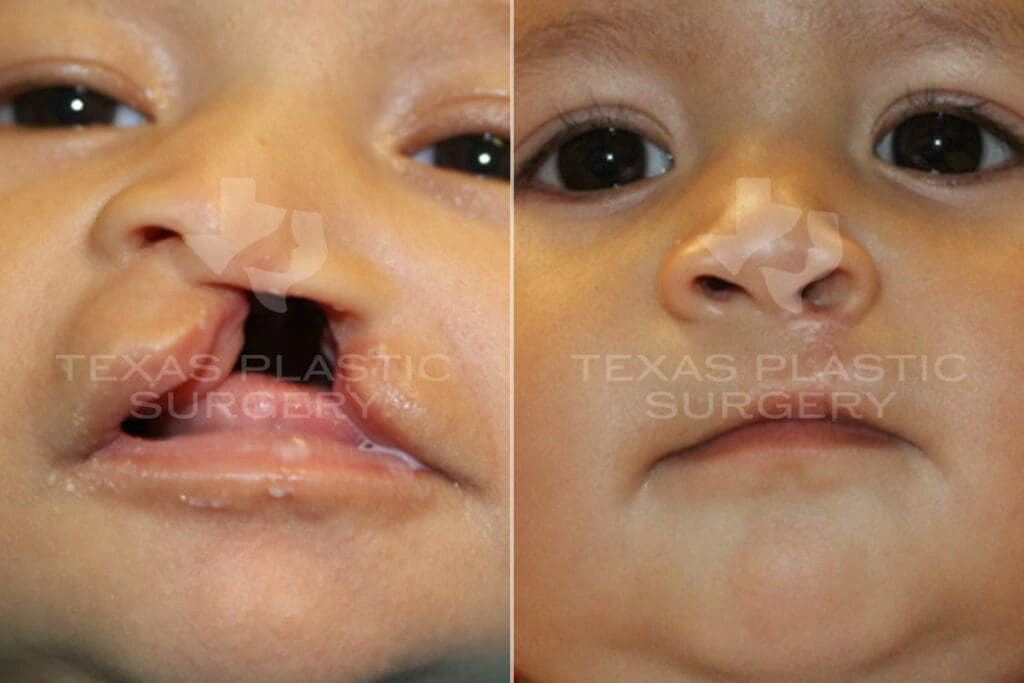 Real Patient results in San Antonio, TX Performed by Texas Plastic Surgery