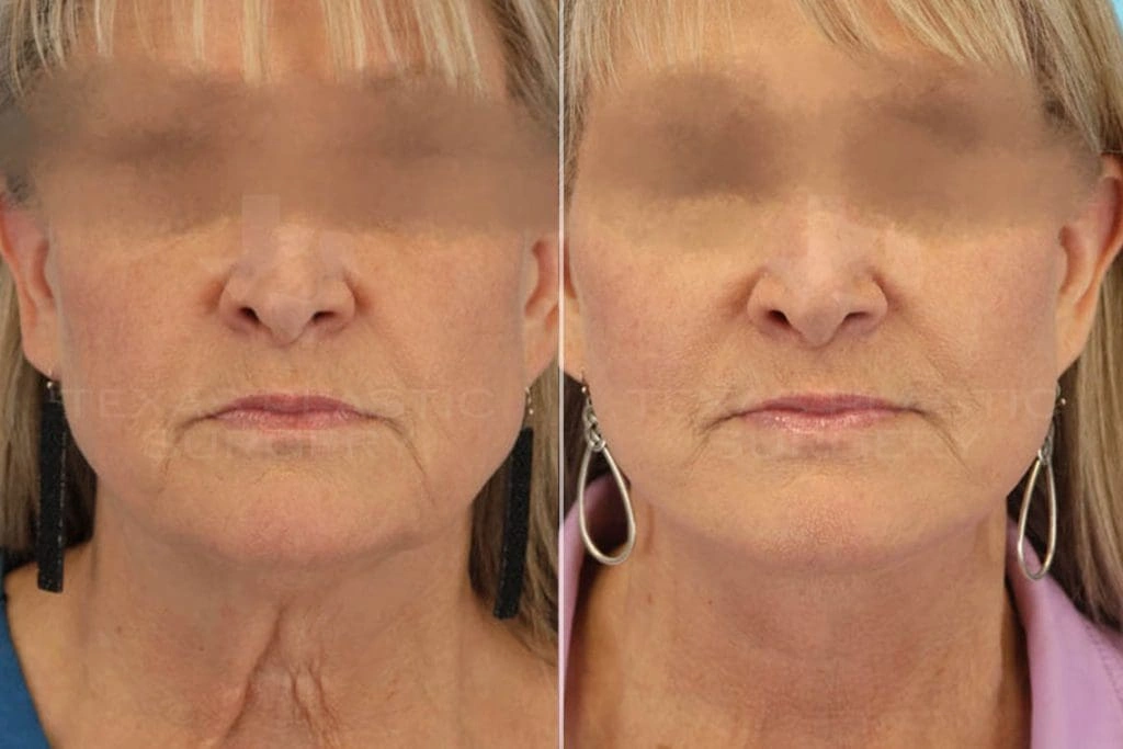 Real Patient results in San Antonio, TX Performed by Texas Plastic Surgery