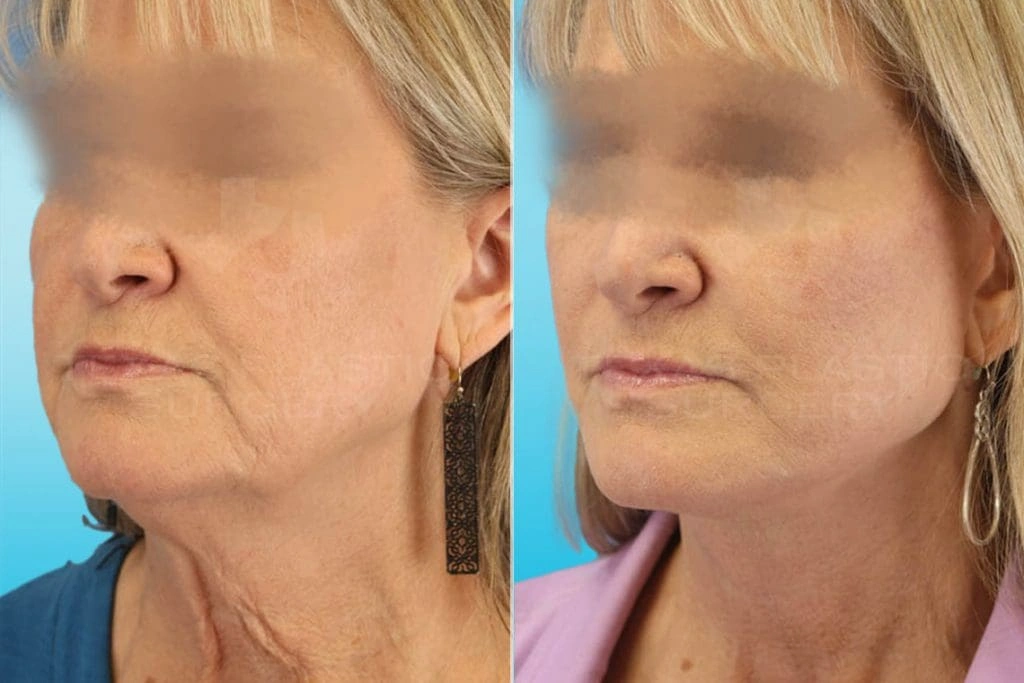 Real Patient results in San Antonio, TX Performed by Texas Plastic Surgery