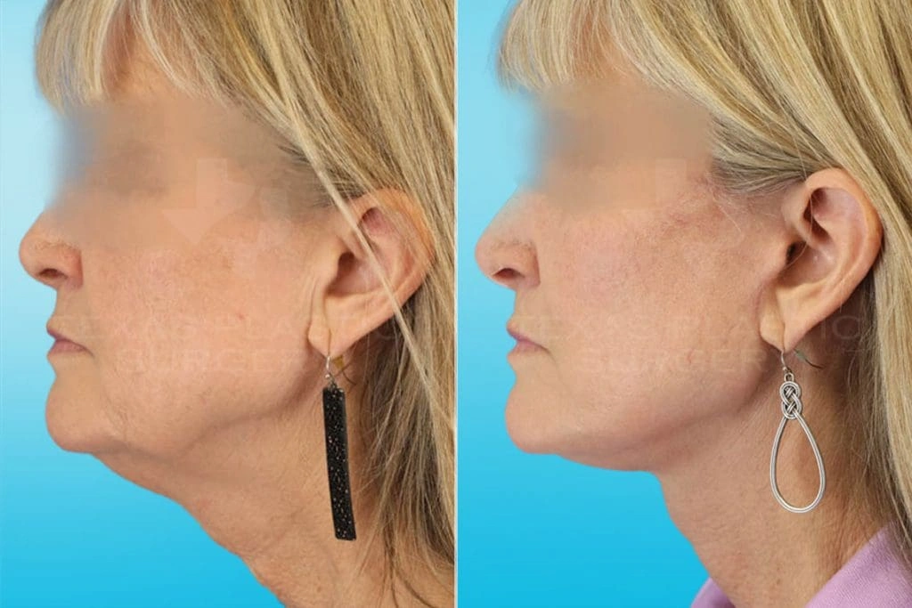 Real Patient results in San Antonio, TX Performed by Texas Plastic Surgery