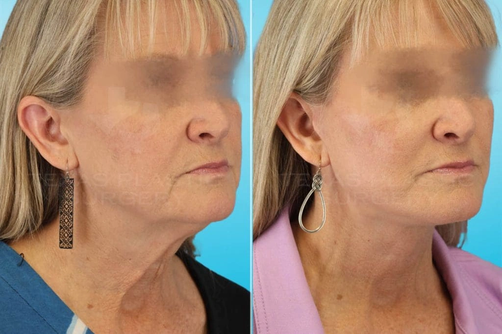 Real Patient results in San Antonio, TX Performed by Texas Plastic Surgery