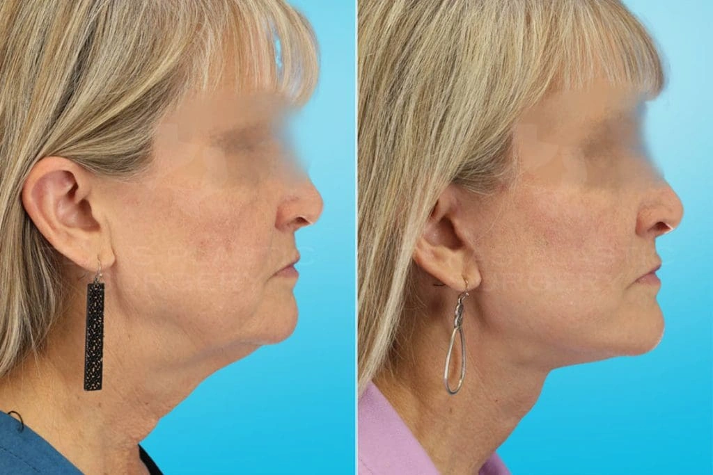 Real Patient results in San Antonio, TX Performed by Texas Plastic Surgery