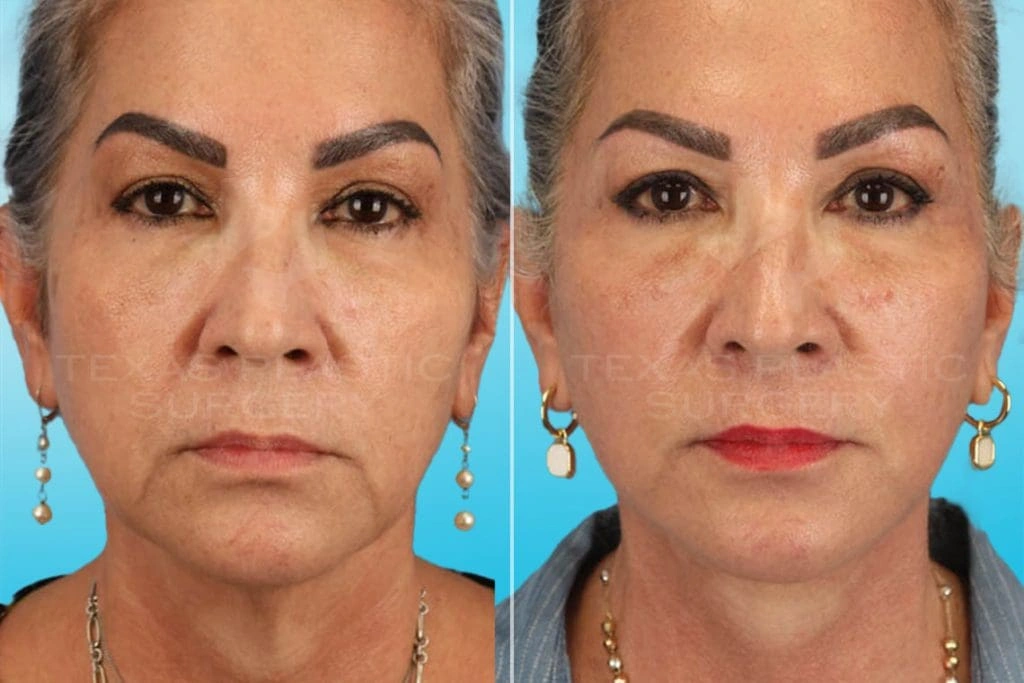 Real Patient results in San Antonio, TX Performed by Texas Plastic Surgery