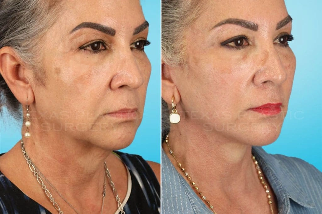 Real Patient results in San Antonio, TX Performed by Texas Plastic Surgery