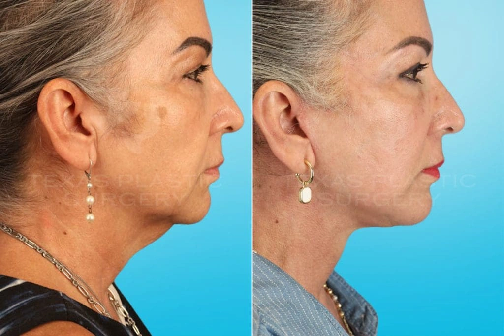Real Patient results in San Antonio, TX Performed by Texas Plastic Surgery