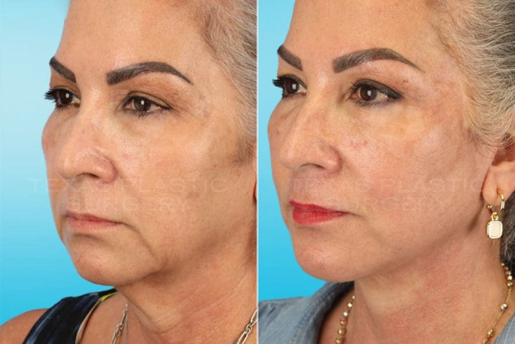 Real Patient results in San Antonio, TX Performed by Texas Plastic Surgery