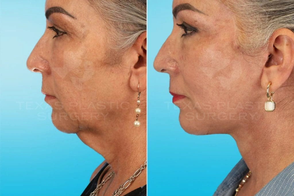 Real Patient results in San Antonio, TX Performed by Texas Plastic Surgery