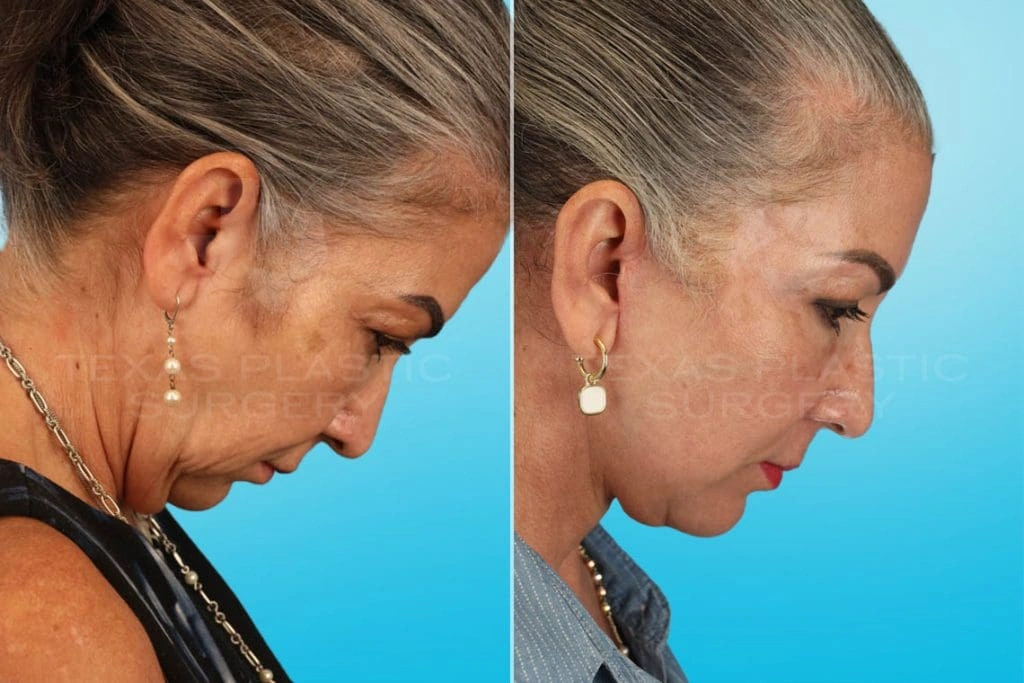 Real Patient results in San Antonio, TX Performed by Texas Plastic Surgery