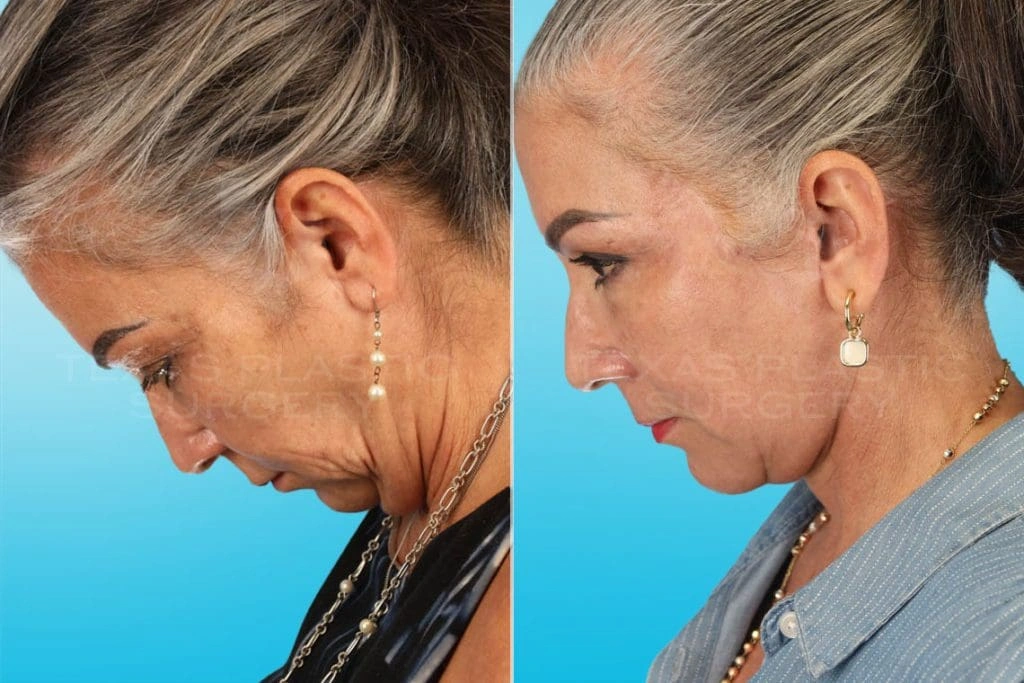 Real Patient results in San Antonio, TX Performed by Texas Plastic Surgery