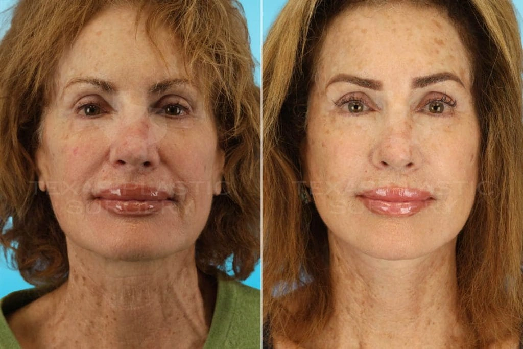 Real Patient results in San Antonio, TX Performed by Texas Plastic Surgery