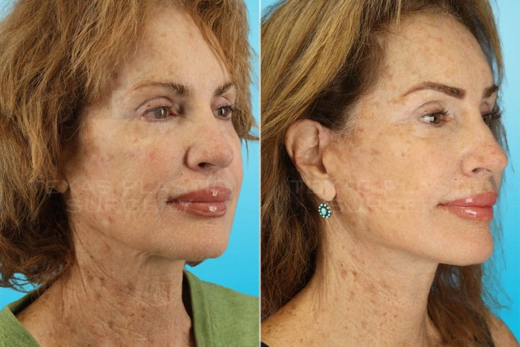 Real Patient results in San Antonio, TX Performed by Texas Plastic Surgery