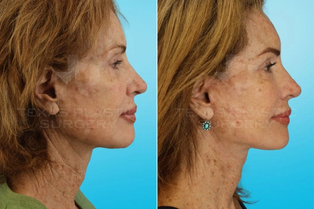 Real Patient results in San Antonio, TX Performed by Texas Plastic Surgery