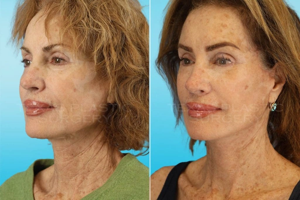 Real Patient results in San Antonio, TX Performed by Texas Plastic Surgery