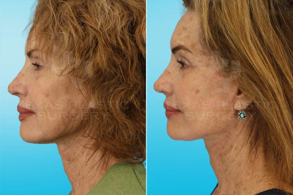 Real Patient results in San Antonio, TX Performed by Texas Plastic Surgery
