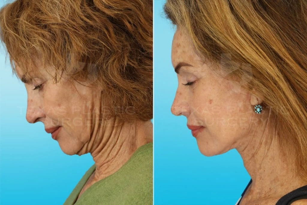Real Patient results in San Antonio, TX Performed by Texas Plastic Surgery