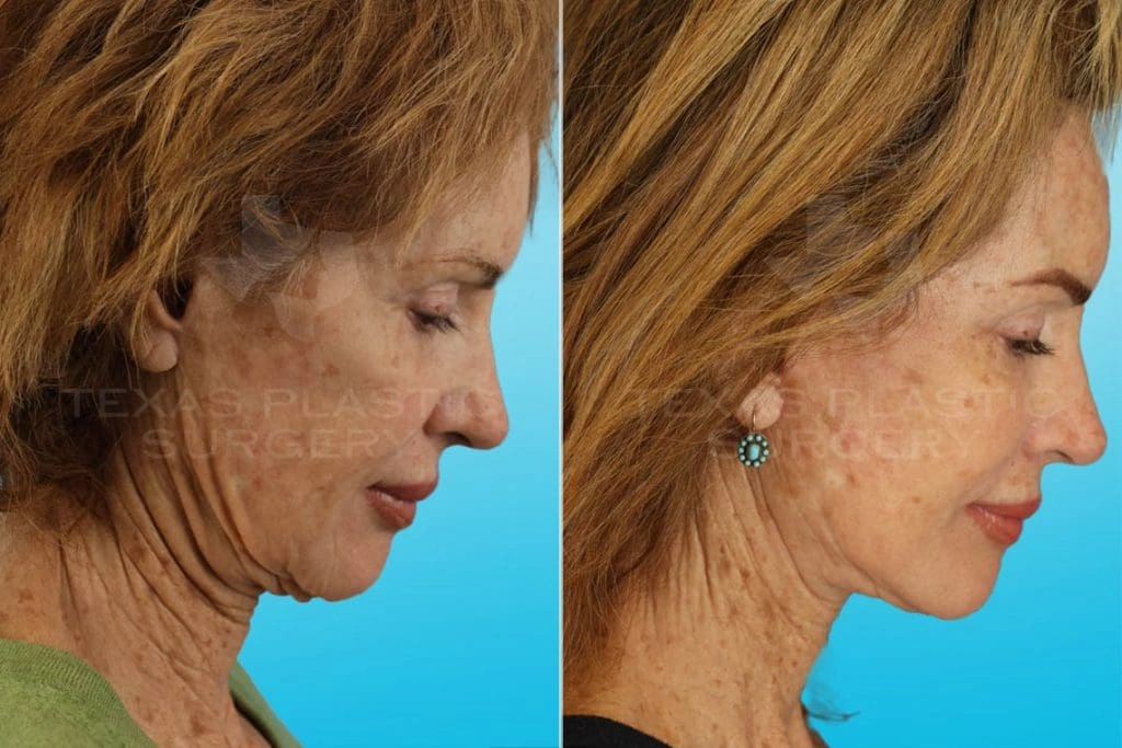 Real Patient results in San Antonio, TX Performed by Texas Plastic Surgery