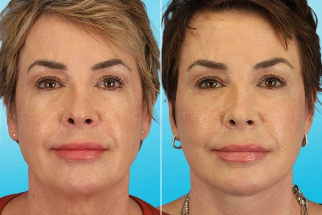 Real Patient results in San Antonio, TX Performed by Texas Plastic Surgery