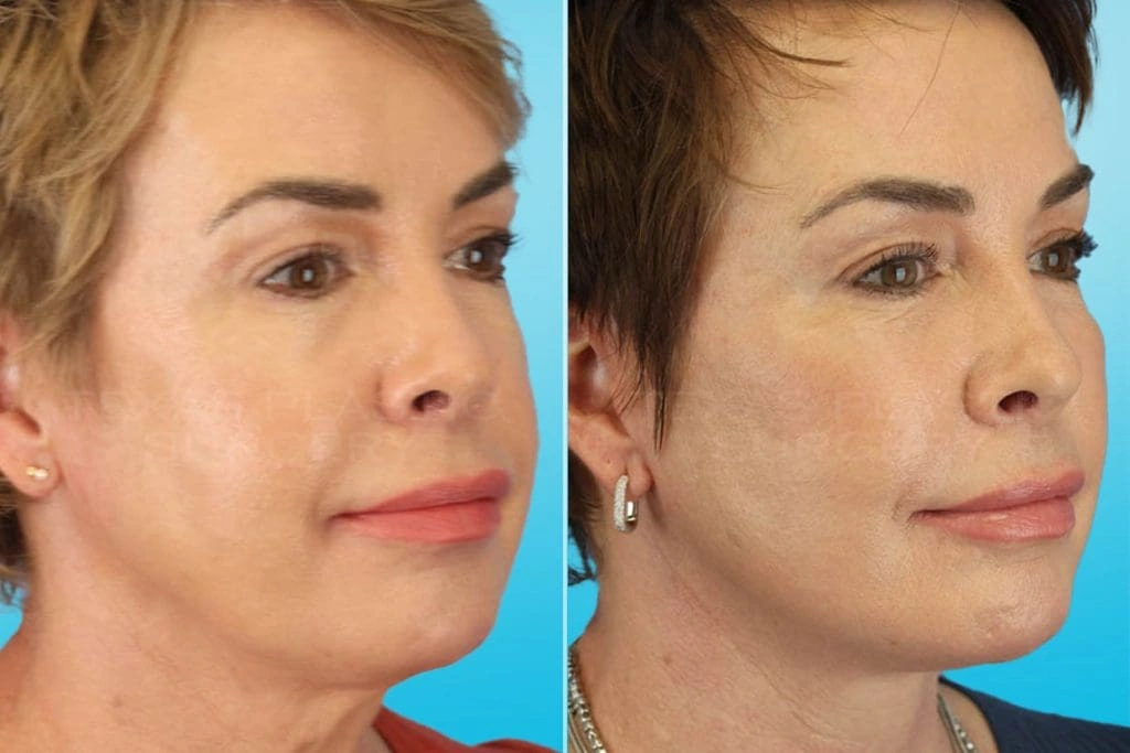 Real Patient results in San Antonio, TX Performed by Texas Plastic Surgery