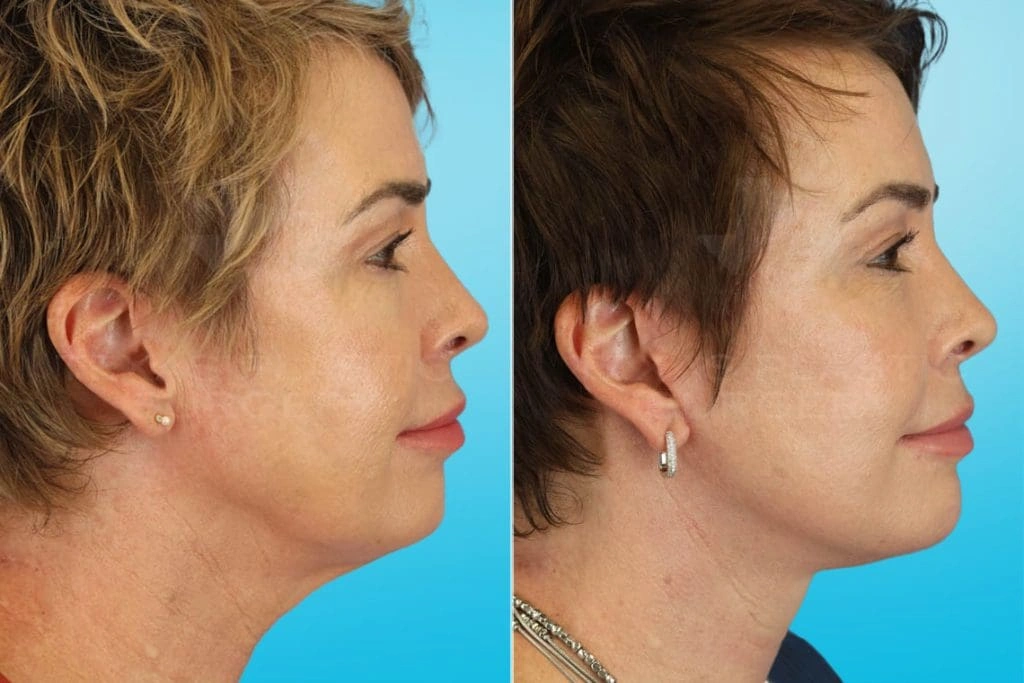 Real Patient results in San Antonio, TX Performed by Texas Plastic Surgery