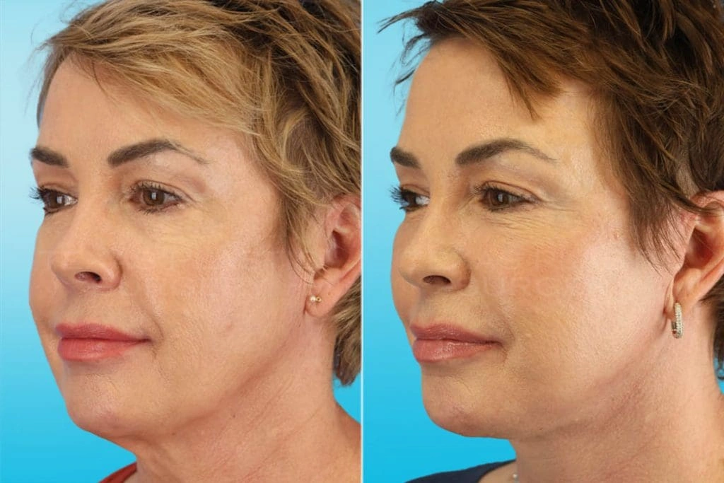 Real Patient results in San Antonio, TX Performed by Texas Plastic Surgery