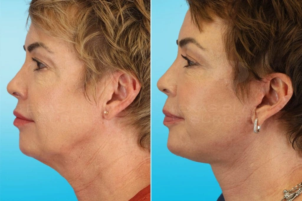 Real Patient results in San Antonio, TX Performed by Texas Plastic Surgery