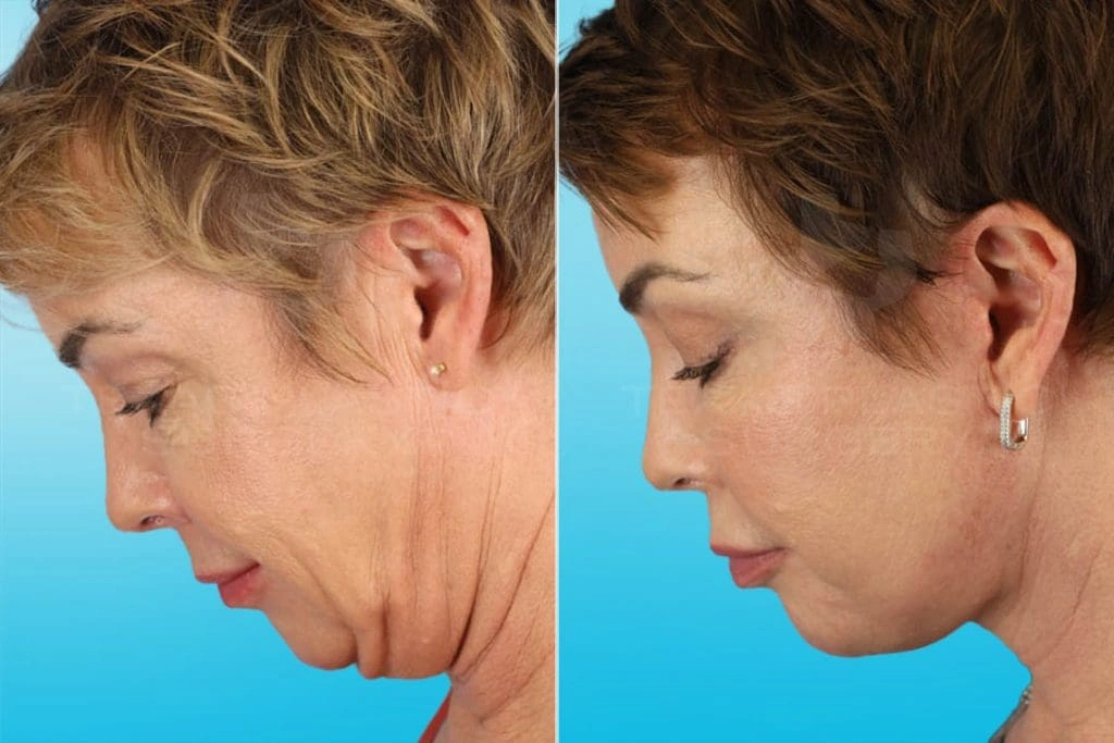 Real Patient results in San Antonio, TX Performed by Texas Plastic Surgery