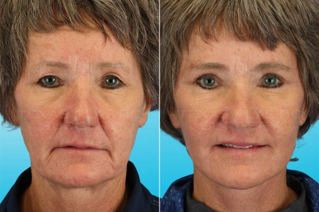 Real Patient results in San Antonio, TX Performed by Texas Plastic Surgery