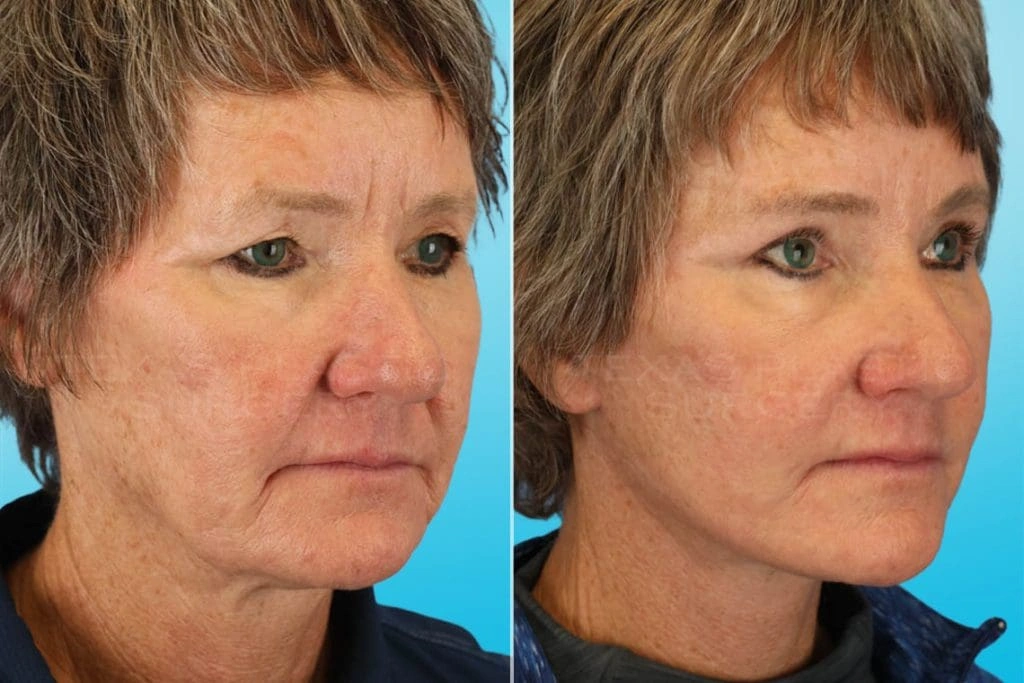 Real Patient results in San Antonio, TX Performed by Texas Plastic Surgery