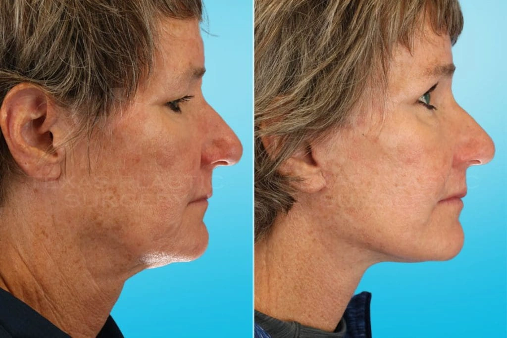 Real Patient results in San Antonio, TX Performed by Texas Plastic Surgery