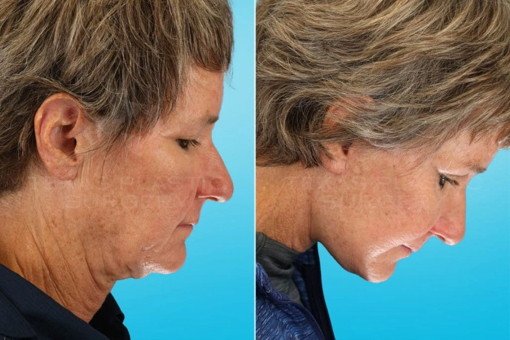 Real Patient results in San Antonio, TX Performed by Texas Plastic Surgery