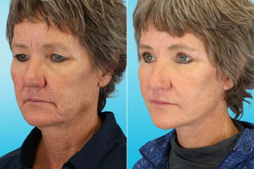 Real Patient results in San Antonio, TX Performed by Texas Plastic Surgery