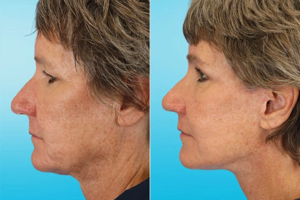 Real Patient results in San Antonio, TX Performed by Texas Plastic Surgery