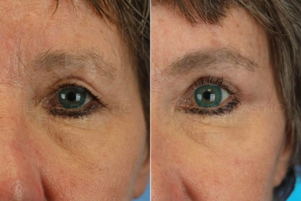 Real Patient results in San Antonio, TX Performed by Texas Plastic Surgery