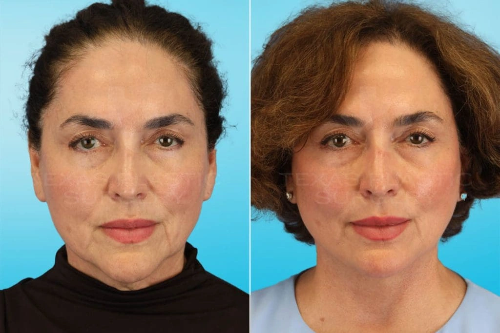 Real Patient results in San Antonio, TX Performed by Texas Plastic Surgery