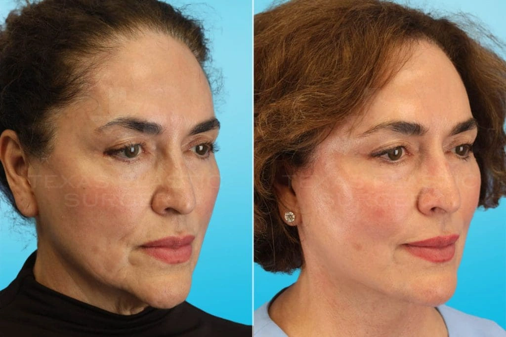 Real Patient results in San Antonio, TX Performed by Texas Plastic Surgery