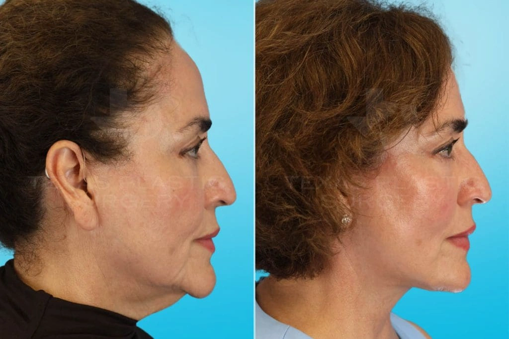 Real Patient results in San Antonio, TX Performed by Texas Plastic Surgery
